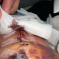 The Role of Gauze in Advanced Wound Care