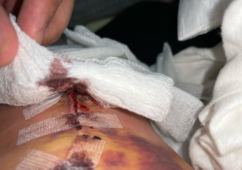 What to do when gauze sticks to a wound?